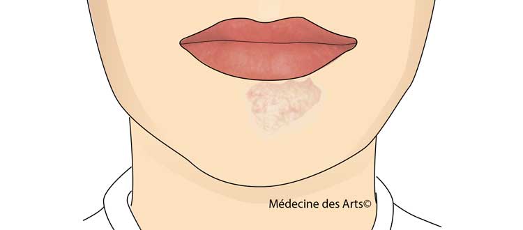 Dermatologie et pratique de la flûte, le menton du flûtiste